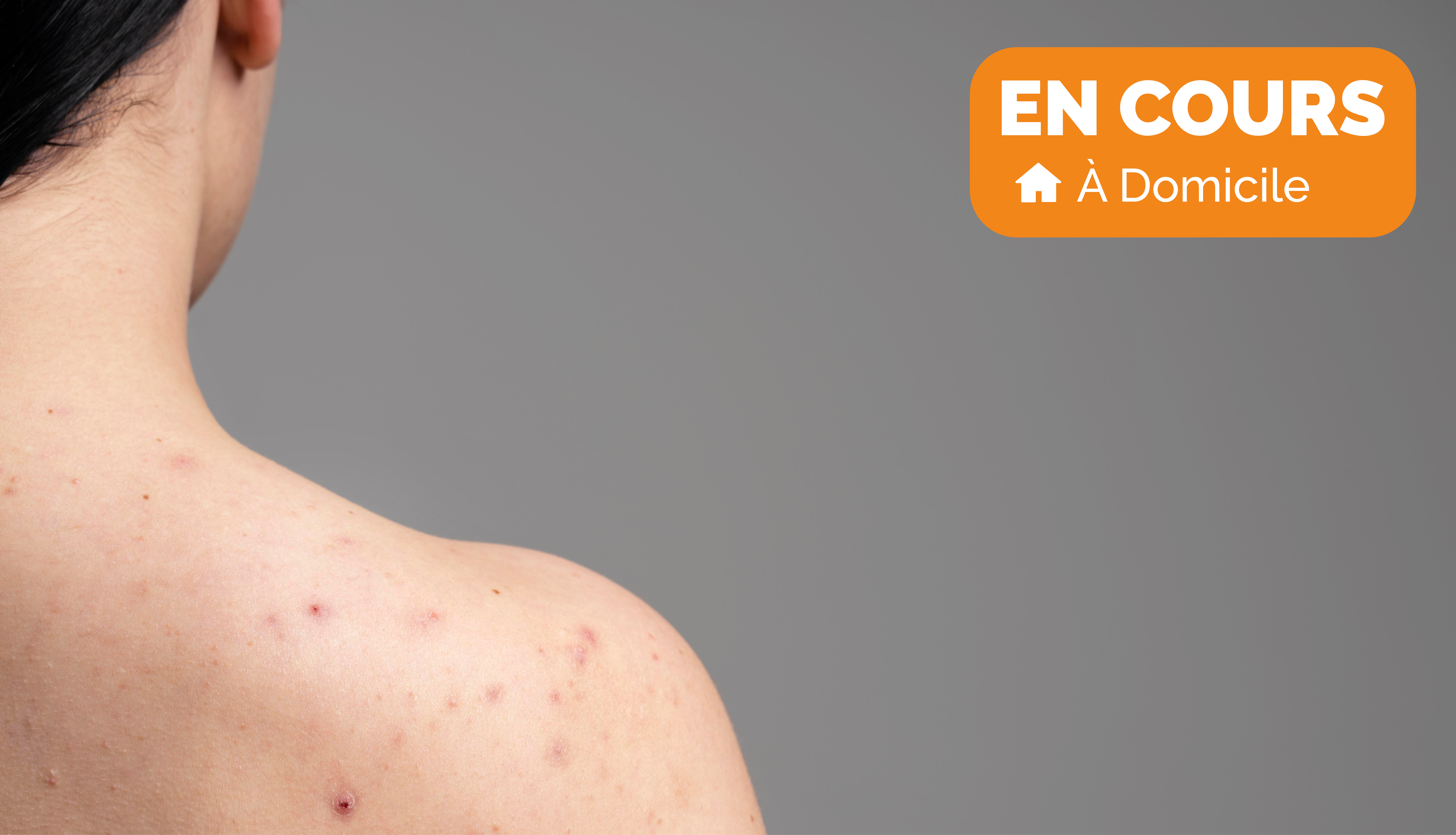 Testez un spray anti-imperfection !